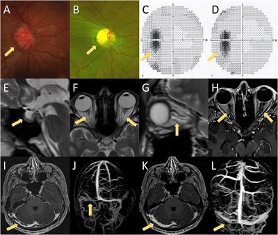 Case Report: Interferon-Alpha-Induced Neuromyelitis Optica Spectrum Disorder